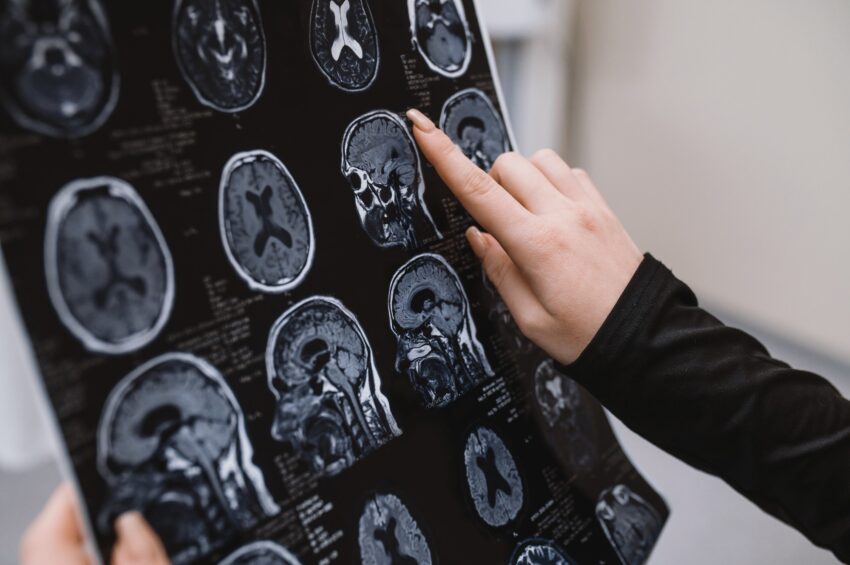 Study: Global, regional, and national burden of stroke and its risk factors, 1990–2021: a systematic analysis for the Global Burden of Disease Study 2021. Image Credit: illustrissima/Shutterstock.com